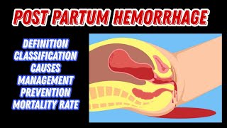 Post Partum Hemorrhage  Causes Classification Treatment  PPH  MisMedicine [upl. by Eimmij]