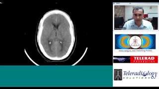 Intracranial Hemorrhage EpiduralSubduralSubarachnoid overview [upl. by Rehtnug]