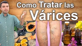 COMO ELIMINAR LAS VARICES PARA SIEMPRE  Tratamientos Naturales Para las Várices en las Piernas [upl. by Tran170]