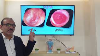 Granular myringitis English Patient teaching programme [upl. by Angle]