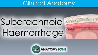 Neurology  Brain Meninges  Epidural Subdural Subarachnoid amp Intracerebral Hematomas [upl. by Oznohpla]