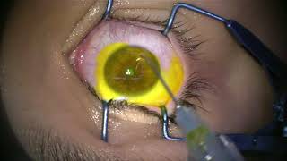 Corneal Collagen Cross Linking for Keratoconus [upl. by Amsirhc]