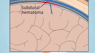 Understanding Subdural Hematoma [upl. by Ahsieket]