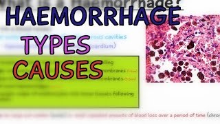 Pathology Lectures Haemorrhage Types and Causes Hemorrhage  EXPLAINED IN 4 MINUTES [upl. by Nosduj]