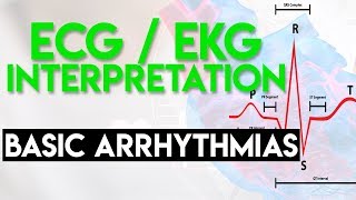 ECG 6 Sinus Rhythms and Supraventricular Tachycardia [upl. by Mellar]