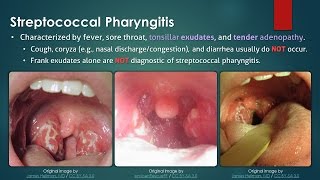 Streptococcal Pharyngitis [upl. by Kathleen]