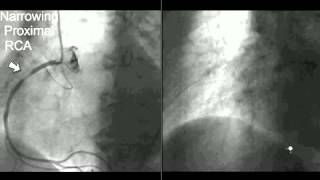 Coronary CT Angiography Cath [upl. by Yelsnit]