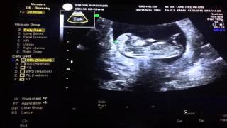 Baby Boy Statons 12 week Checkup NT ScanReadouts [upl. by Ahilam]