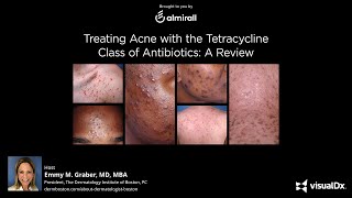 Treating Acne with the Tetracycline Class of Antibiotics A Review [upl. by Olcott536]