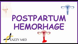 Postpartum Hemorrhage PPH causesrisk factorsprevention and treatment [upl. by Esined]