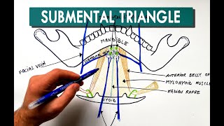 Subarachnoid Hemorrhage radiology teaching by Dr Arjun Kalyanpur [upl. by Hegarty]