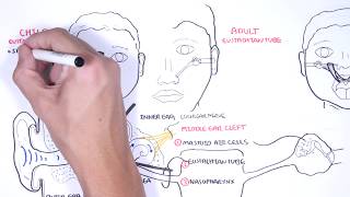 Acute Otitis Media Causes Pathophysiology signs and symptoms treatment and complications [upl. by Geanine]