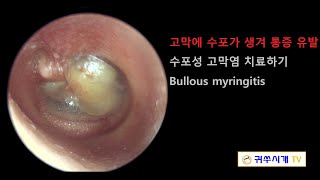 Bullous myringitis 수포성 고막염 [upl. by Sedberry634]