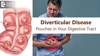 Diverticular Disease Intestinal Pouch  Cause Symptom TreatmentDrRajasekhar MR Doctors Circle [upl. by Carmina]