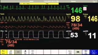 Sudden Cardiac Arrest SCA [upl. by Wallace]