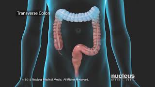 Colon Problems Diverticular Disease [upl. by Eniale]