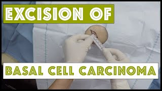 Excision of a basal cell carcinoma on the thigh wearing my GoPro [upl. by Bailey]