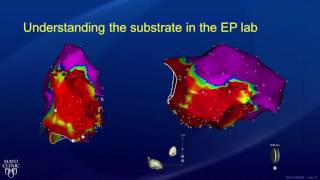 AVRNT atrioventricular reentry tachycardia  causes pathophysiology treatment [upl. by Sylvanus678]