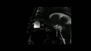 Keratoconus Eye rubbing MRI Keratocone frottements oculaires IRM [upl. by Yessak431]