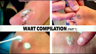 WART BURNING COMPILATION Part 14  Dr Paul [upl. by Alvar]