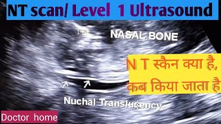 NT scan Level 1 ultrasound Pregnancy ultrasound Doctor home [upl. by Olympie856]