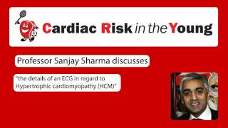 ECG 2 Hypertrophic cardiomyopathy HCM [upl. by Sillert818]