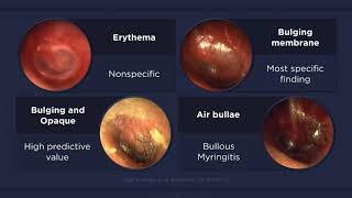 Acute Otitis Media Otoscopic Findings [upl. by Gilbertson619]