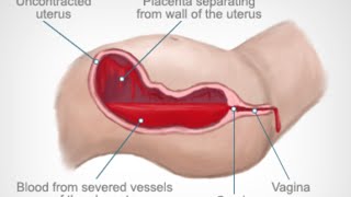 Postpartum Hemorrhage [upl. by Etnoved]