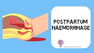 Postpartum Haemorrhage [upl. by Dviad]