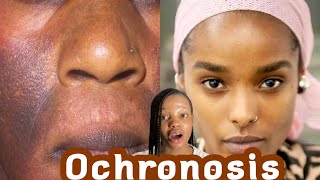 How To Get Rid Of OchronosisampHow To Avoid Having OCHRONOSIS Knowing Product That Causes Ochronosis [upl. by Lekcim953]