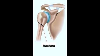 Fisioterapia quotFractura de Humeroquot [upl. by Arim357]